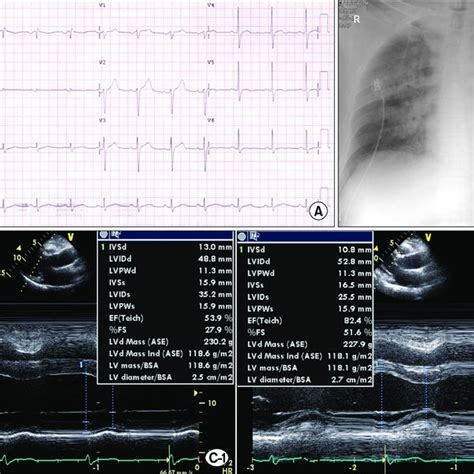 Electrocardiogram Ecg Chest X Ray And Transthoracic Echocardiography