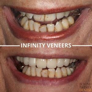 Veneers For Crooked Teeth – An Alternative To Orthodontic Treatment