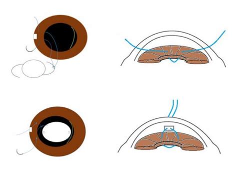 Cataract Surgery & Iris Fixation IOL Technique - Cataract Patients