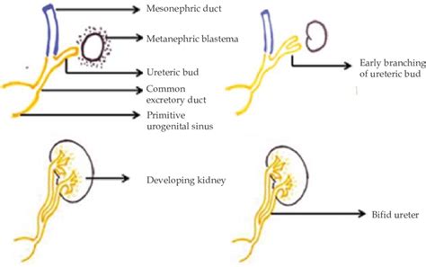 embryological basis  bifid ureter  scientific diagram