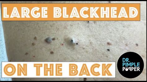 Dr Pimple Popper Massive Blackheads 2021