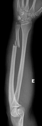 Isolated Ulnar Shaft Fracture Bilateral Radiology Case