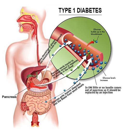 What Happens In The Body With Type 1 Diabetes Diabeteswalls