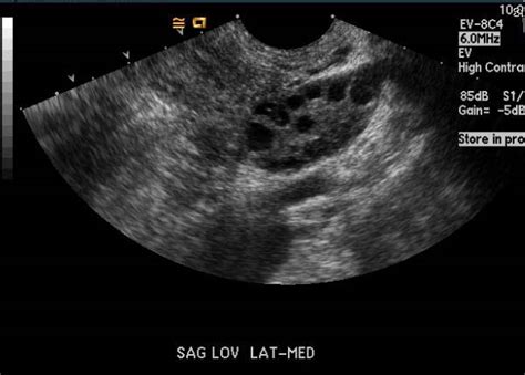 Polycystic ovary syndrome ultrasound - wikidoc