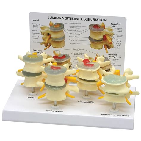 4 Stage Vertebrae Model Set 1019512 1760 Human Anatomical