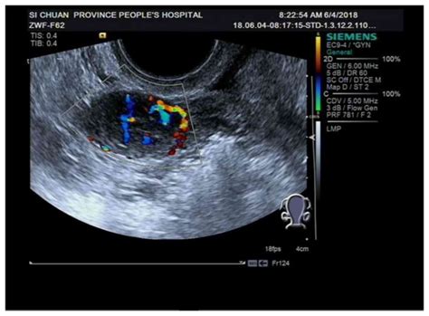 Comparison Of Image Features And Diagnostic Value Of Color Doppler