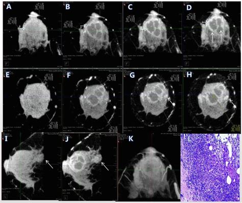 Imaging Manifestations Of Idiopathic Granulomatous Lobular Mastitis On