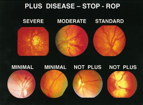 Standard Photographs For The STOP ROP Study Fundus Photographs Of The