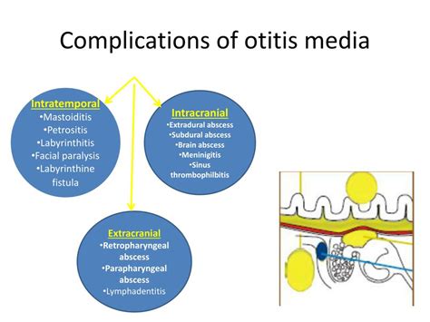 Ppt The Complications Of Acute And Chronic Otitis Media Powerpoint Presentation Id6339071