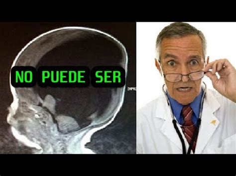 El Inexplicable Caso Del Genio Matem Tico Que No Ten A Cerebro Youtube