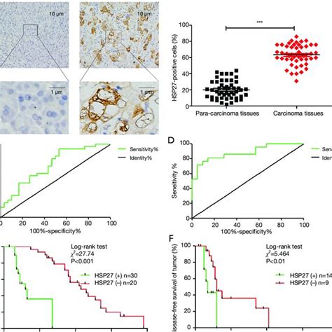 High Expression Of Hsp In Pdac Tissues And Association With Poor