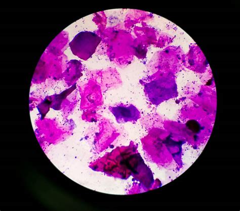 Staphylococcus Aureus Gram Stain 100x