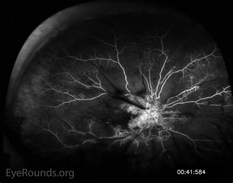 Atlas Entry Proliferative Diabetic Retinopathy Pdr