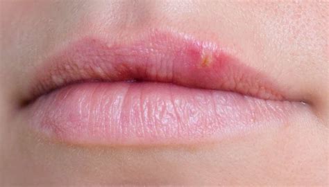 Bump On Lip Causes Treatment And When To See A Doctor