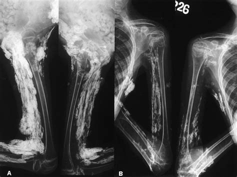 Clinical Images Calcinosis Universalis Complicating Juvenile