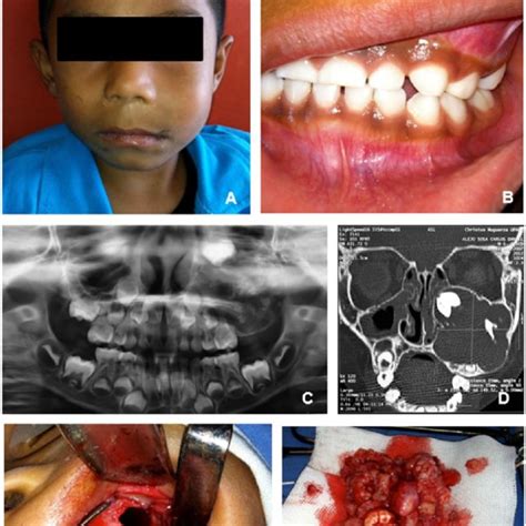 A Ameloblastic Fibro Odontoma AFO Causing Swelling Of The Left