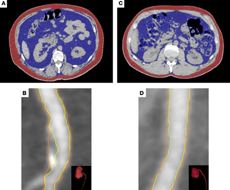 Visceral Adiposity And Noncalcified Coronary Artery Burden In