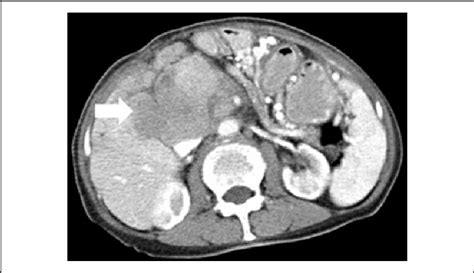 Preoperative Contrast Enhanced Computed Tomography Ct Scan In A