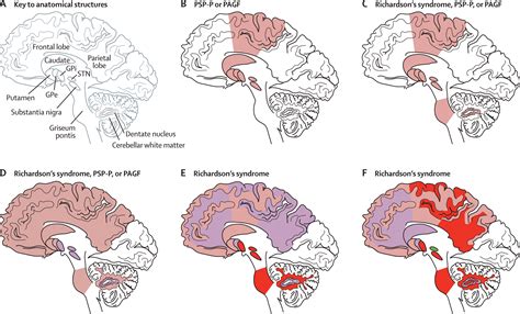 Progressive Supranuclear Palsy Clinicopathological Concepts And Diagnostic Challenges The