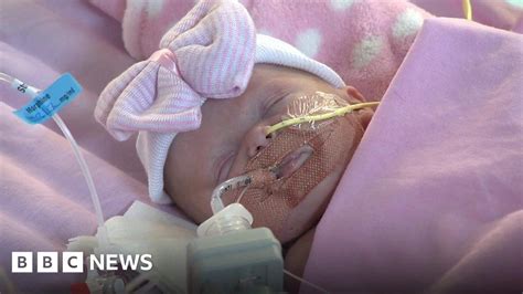 Baby Born With Heart Outside Chest BBC News