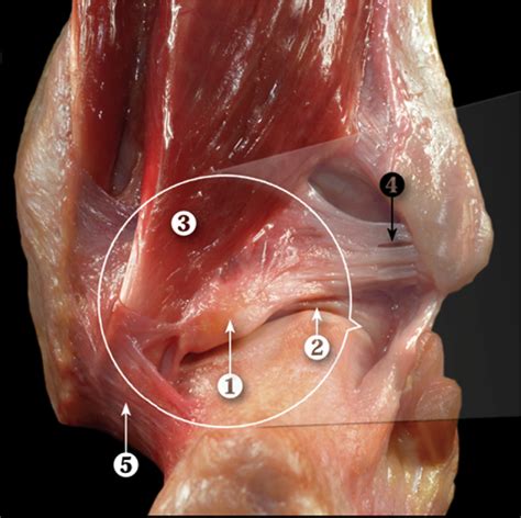 Endoscopic View Of Posterior Region Of Ankle Compared With Anatomic