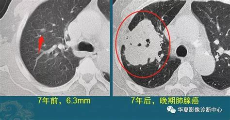 磨玻璃肺结节到晚期肺癌随访4种结局肺癌结节结局新浪新闻