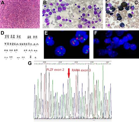 Frontiers Spinal Myeloid Sarcoma Presenting As Initial Symptom In