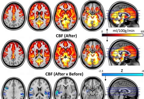 Psilocybin May Reset Key Brain Circuits To Reduce Depression