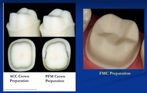 Molar Crown Preparation