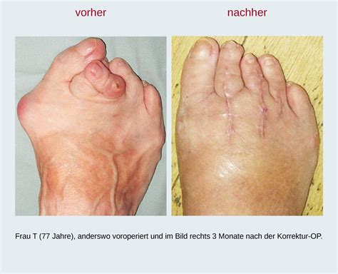 Hallux Valgus Operation Michael Vitek Dr Prof Inv Uag