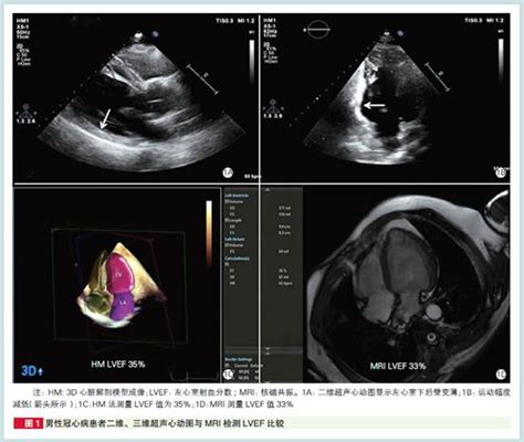 评估心功能心脏超声三维成像效果堪比磁共振阜外王浩团队经验 每日头条