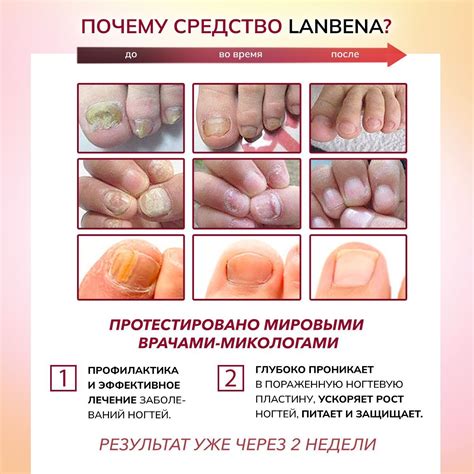 Средство для ногтей от грибка на ногах, бесцветный гель LANBENA / Уход ...