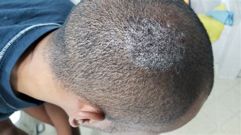 What Are White Spots On Scalp - Printable Templates Free