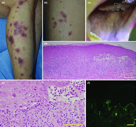 A Shiny Violaceous Flat Topped Polygonal Papules And Plaques On The Download Scientific