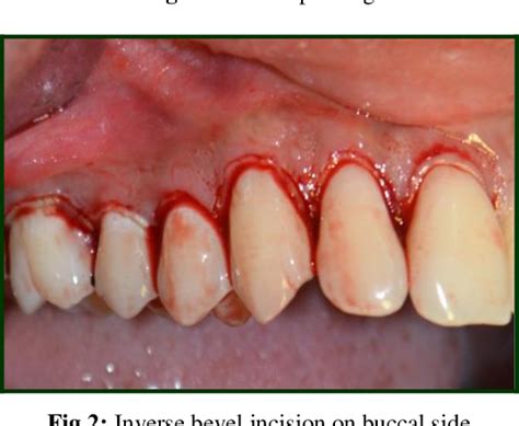 Figure 2 From Open Flap Debridement Using Microsurgical Loupes And