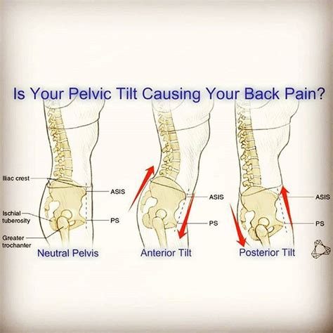 If Your Pelvis Is Stuck In An Anterior Or Posterior Tilt It May Be