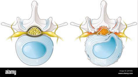 Ilustración que muestra la estenosis del canal espinal Vértebra lumbar