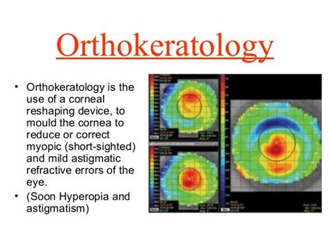 Orthokeratology Power Point Presentation