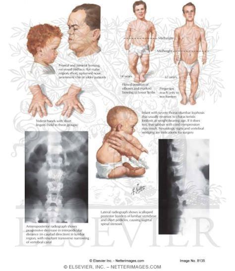 Achondroplasia