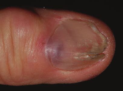 Type C Myxoid Cyst Located Beneath The Nail Matrix With Consequent