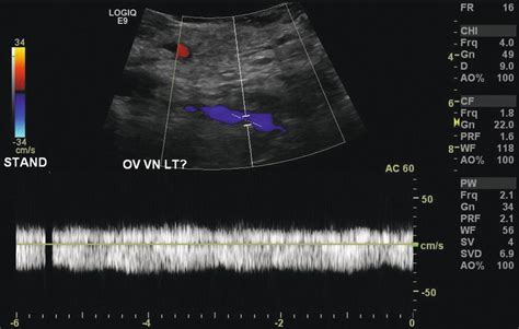 Pelvic Congestion Syndrome Thoracic Key