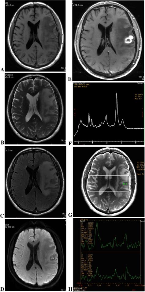 T Weighted Image A T Weighted Image B Flair C Dwi D