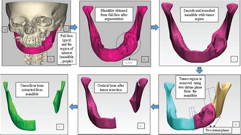 A Comparative Study On The Customized Design Of Mandibular