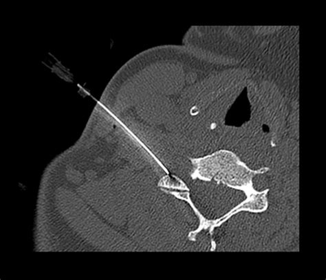 Cervical Transforaminal Epidural Steroid Injection Ct Guided Image