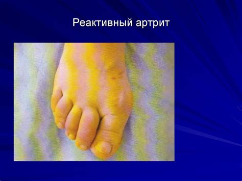 Реактивный Артрит Рентгенологические Признаки — Buy-artox.ru
