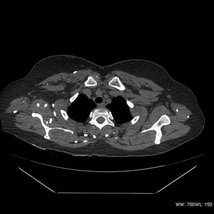 Cysticercosis Radiology Reference Article Radiopaedia Org