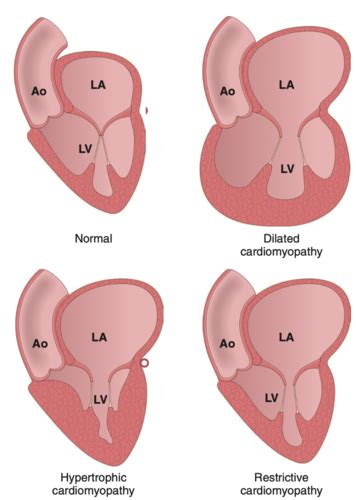 Module Detailed Overview Of Cardiology Cardiomyopathy And Valvular