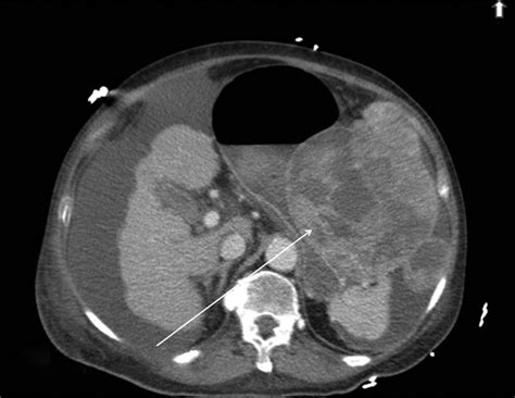 Computed tomography image showing HCC invading into greater curvature ...