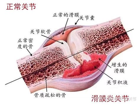 膝关节积液的原因、预防、治疗及康复训练 知乎