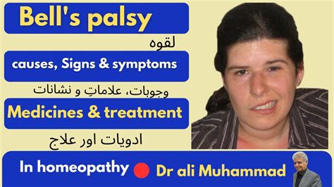 Bells Palsy لقوہ Symptoms Medicines Treatment In Homeopathy Dr